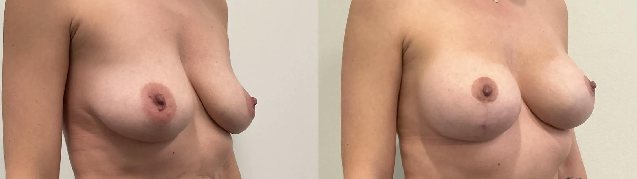 Breast Augmentation Before & After Gallery - Patient 344525 - Image 2