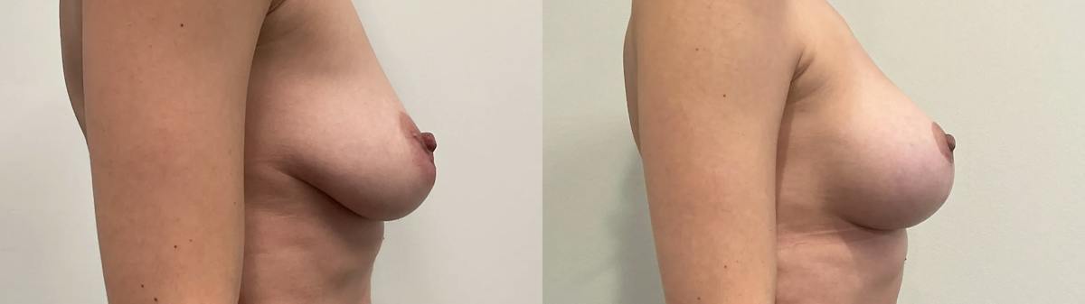 Breast Augmentation Before & After Gallery - Patient 344525 - Image 3