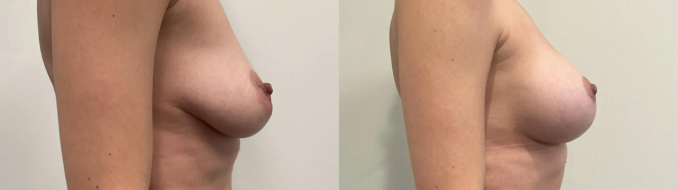 Breast Augmentation Before & After Gallery - Patient 344525 - Image 3