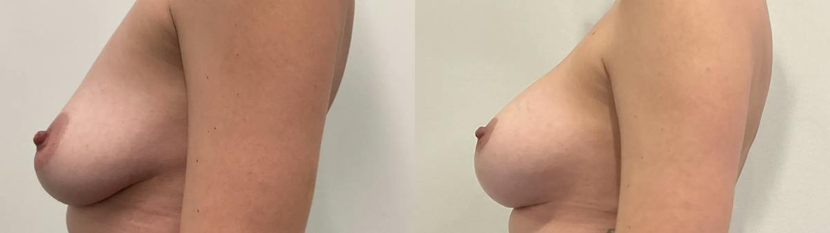 Breast Augmentation Before & After Gallery - Patient 344525 - Image 4