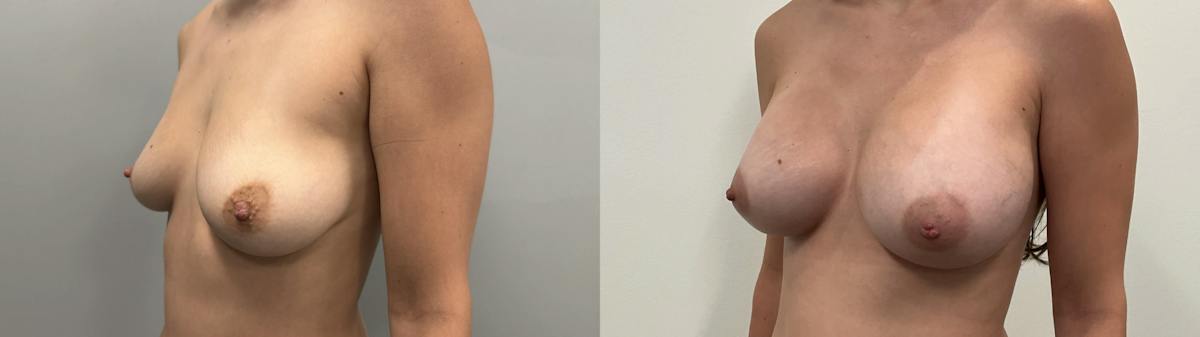 Breast Augmentation Before & After Gallery - Patient 304363 - Image 2