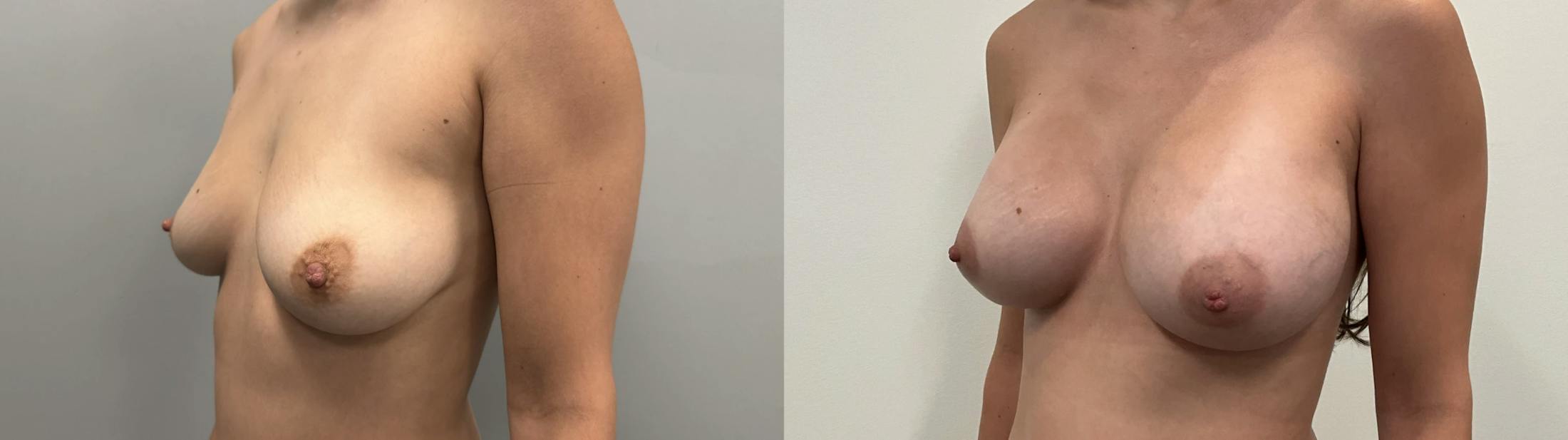 Breast Augmentation Before & After Gallery - Patient 304363 - Image 2