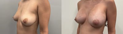 Breast Augmentation Before & After Gallery - Patient 304363 - Image 2