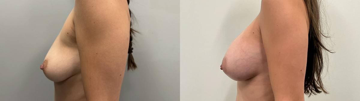 Breast Augmentation Before & After Gallery - Patient 304363 - Image 3