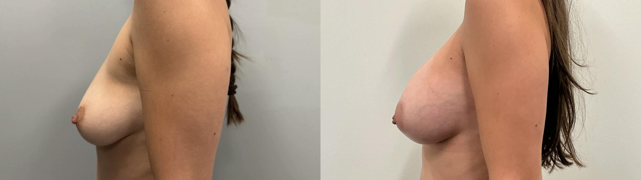 Breast Augmentation Before & After Gallery - Patient 304363 - Image 3