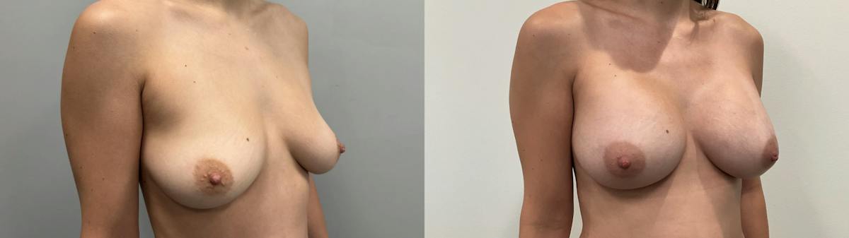 Breast Augmentation Before & After Gallery - Patient 304363 - Image 4