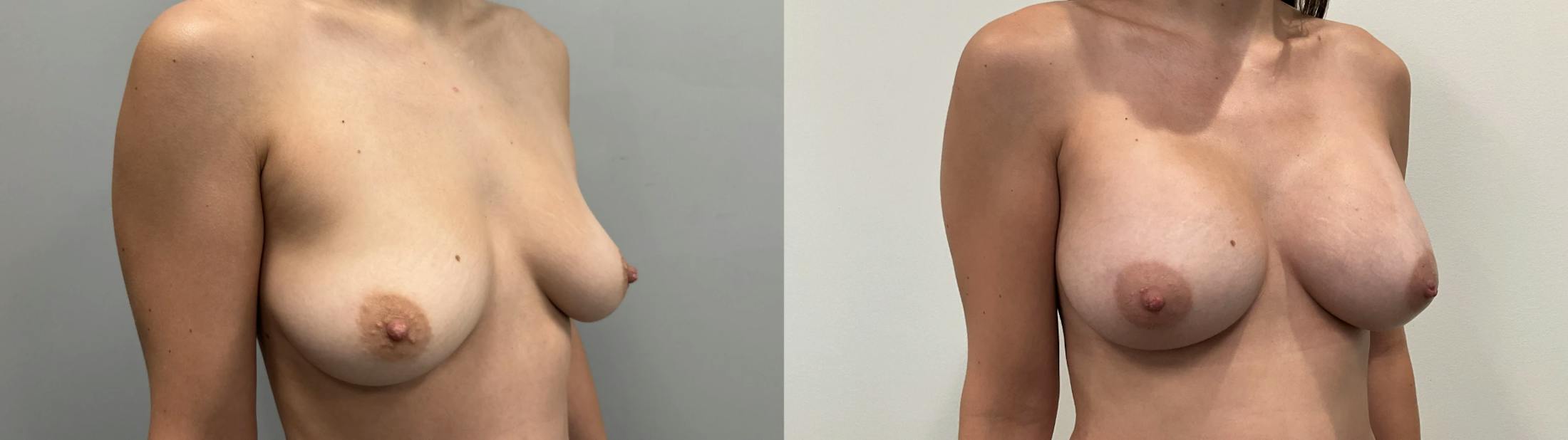 Breast Augmentation Before & After Gallery - Patient 304363 - Image 4