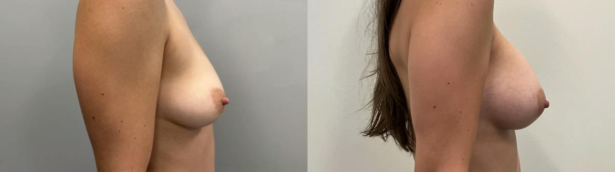 Breast Augmentation Before & After Gallery - Patient 304363 - Image 5