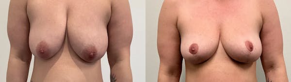 Breast Lift Before & After Gallery - Patient 275709 - Image 1