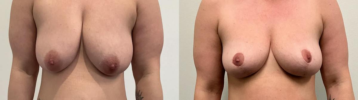 Breast Lift Before & After Gallery - Patient 275709 - Image 1