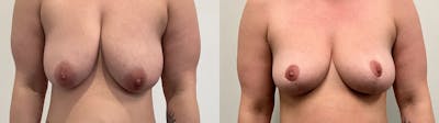 Breast Lift Before & After Gallery - Patient 275709 - Image 1