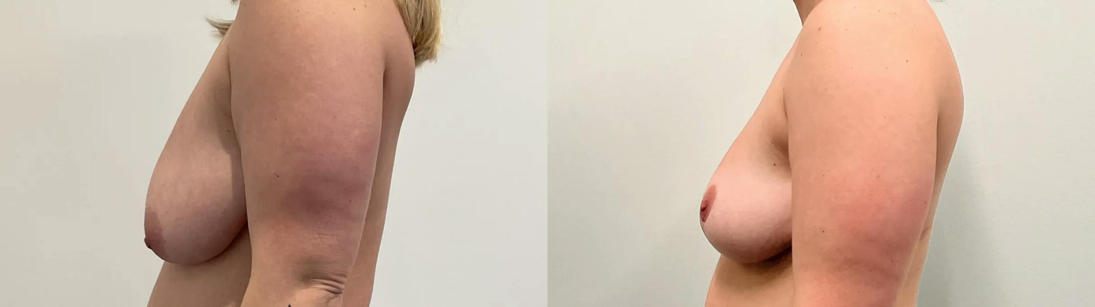 Breast Lift Before & After Gallery - Patient 275709 - Image 2
