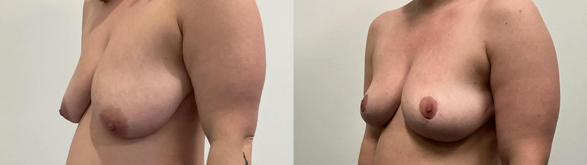 Breast Lift Before & After Gallery - Patient 275709 - Image 3