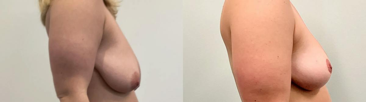Breast Lift Before & After Gallery - Patient 275709 - Image 4