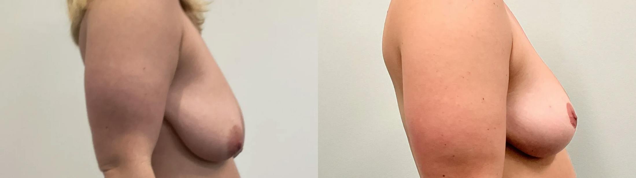 Breast Lift Before & After Gallery - Patient 275709 - Image 4