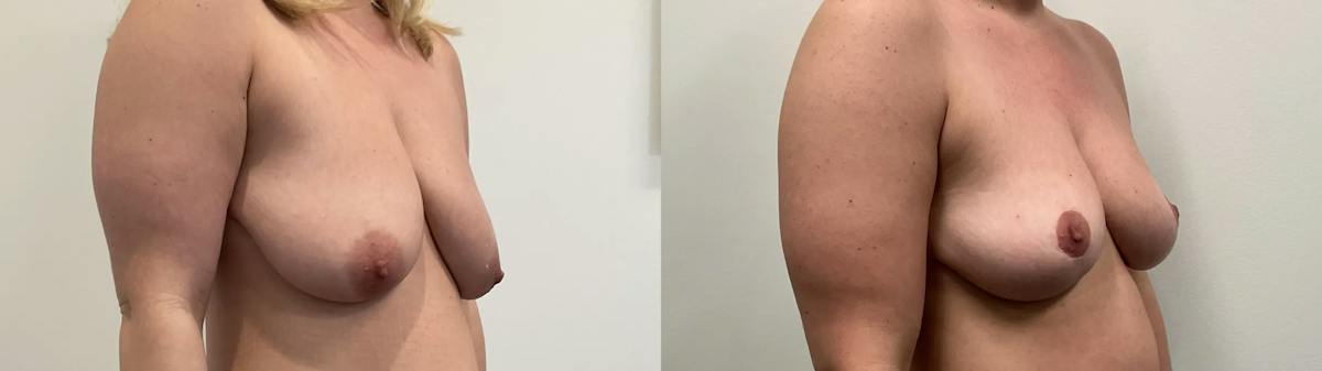 Breast Lift Before & After Gallery - Patient 275709 - Image 5