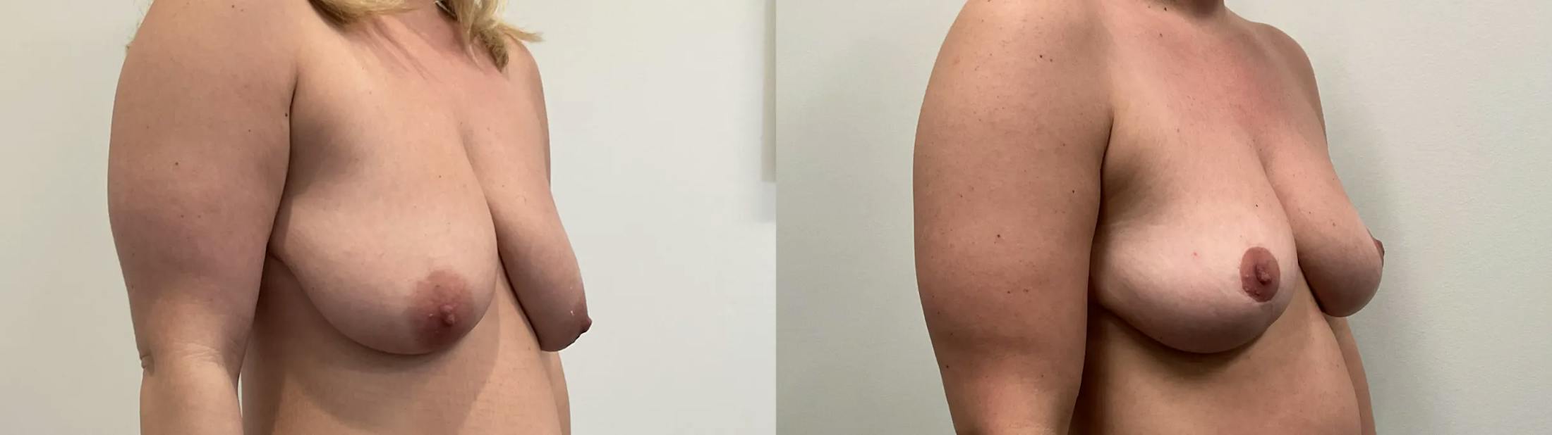 Breast Lift Before & After Gallery - Patient 275709 - Image 5