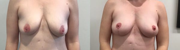 Breast Lift Before & After Gallery - Patient 257542 - Image 1