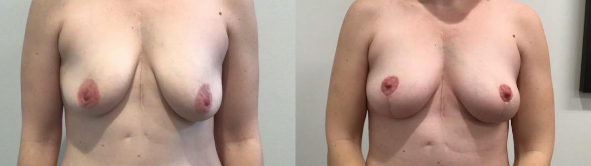 Breast Lift Before & After Gallery - Patient 257542 - Image 1