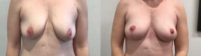 Breast Lift Before & After Gallery - Patient 257542 - Image 1