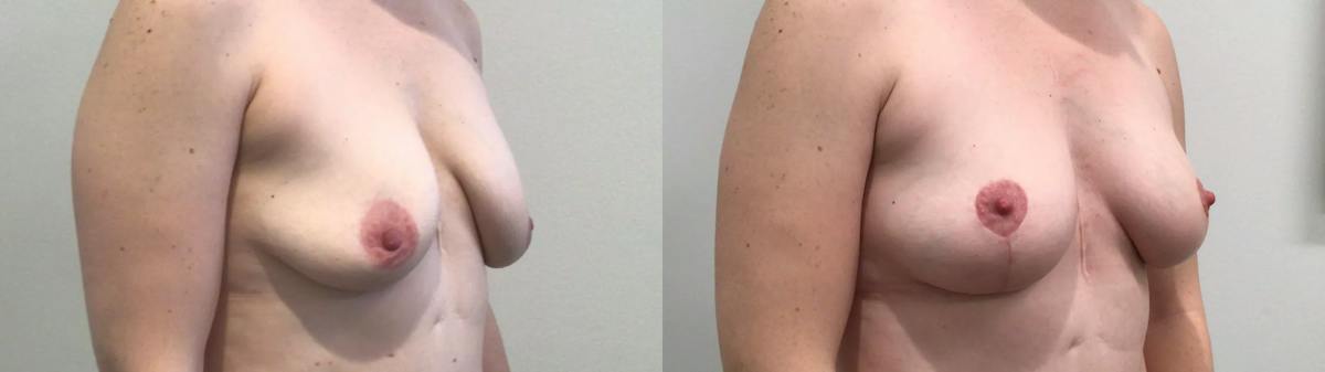 Breast Lift Before & After Gallery - Patient 257542 - Image 2