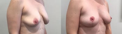 Breast Lift Before & After Gallery - Patient 257542 - Image 2