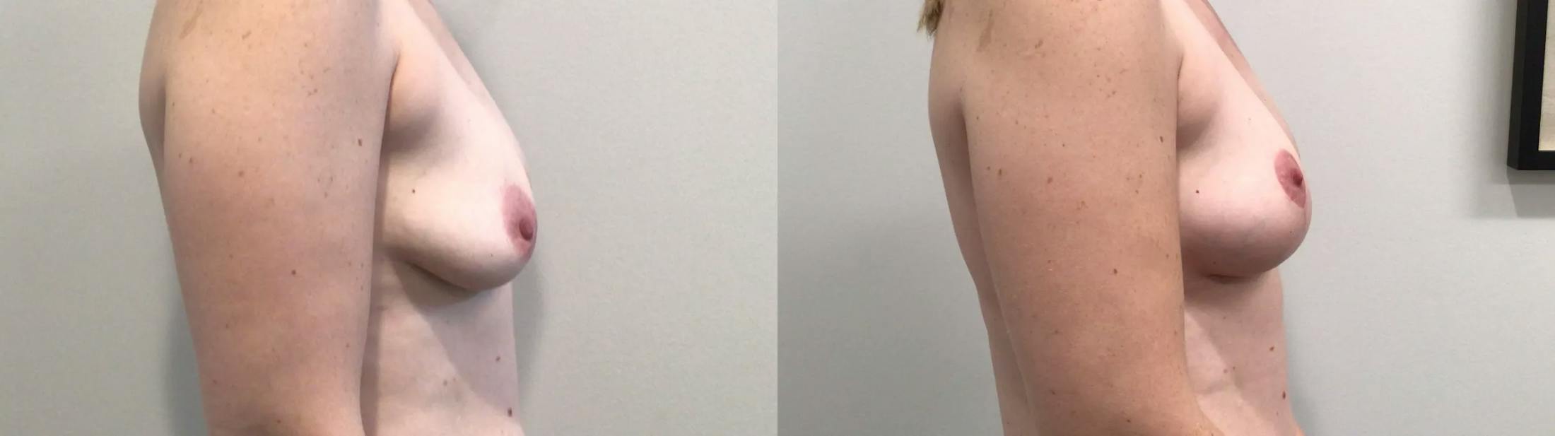 Breast Lift Before & After Gallery - Patient 257542 - Image 3