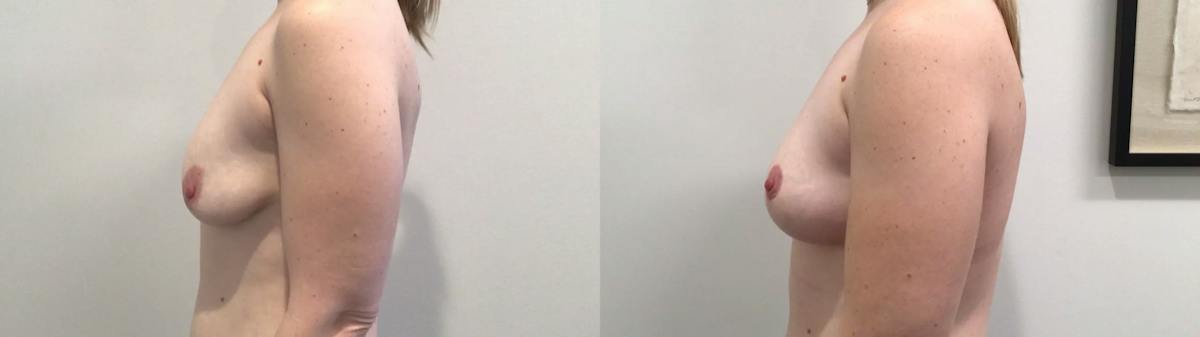 Breast Lift Before & After Gallery - Patient 257542 - Image 4