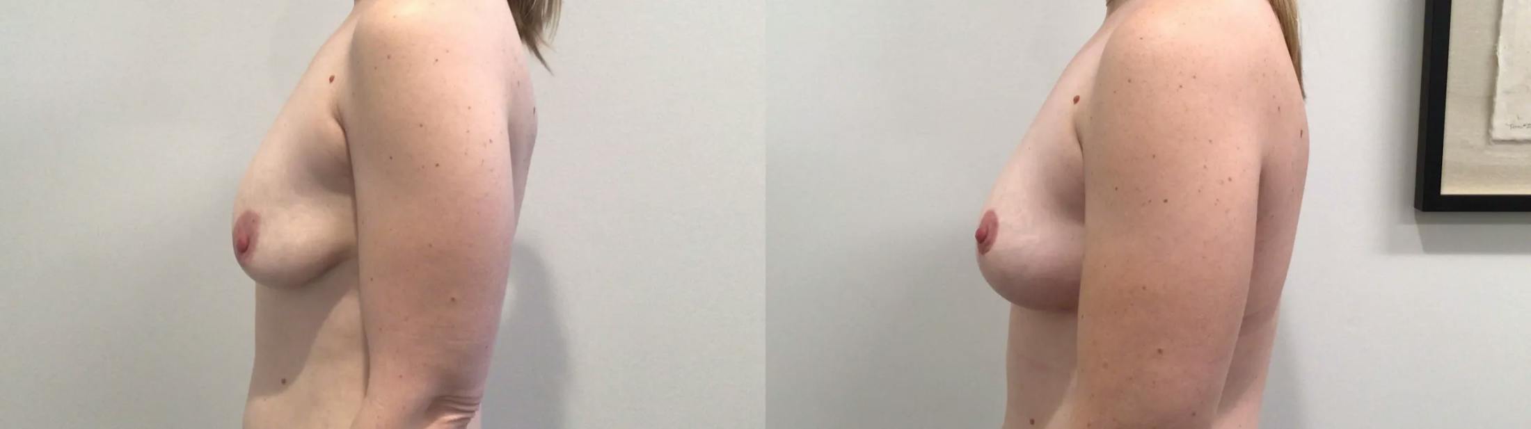 Breast Lift Before & After Gallery - Patient 257542 - Image 4