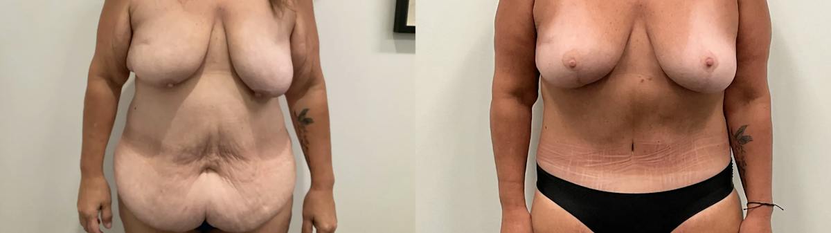 Tummy Tuck Before & After Gallery - Patient 247048 - Image 1