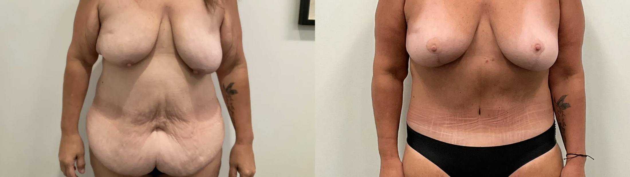 Tummy Tuck Before & After Gallery - Patient 247048 - Image 1