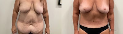 Tummy Tuck Before & After Gallery - Patient 247048 - Image 1