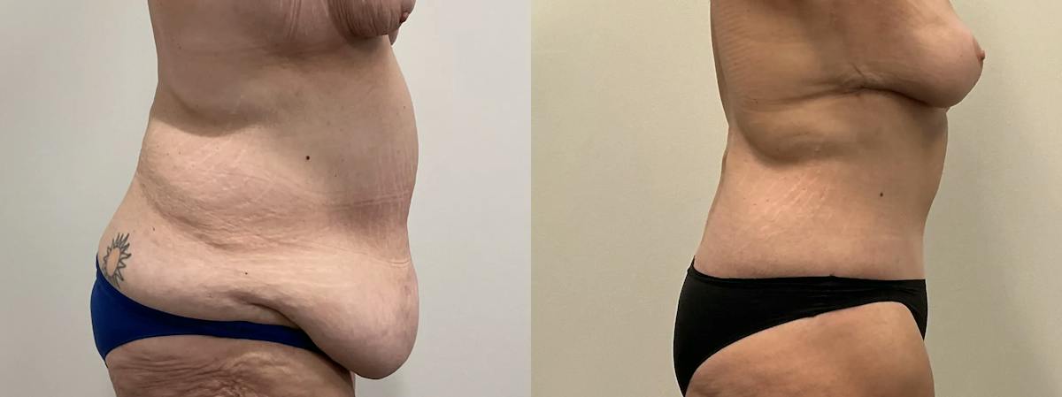 Tummy Tuck Before & After Gallery - Patient 247048 - Image 2