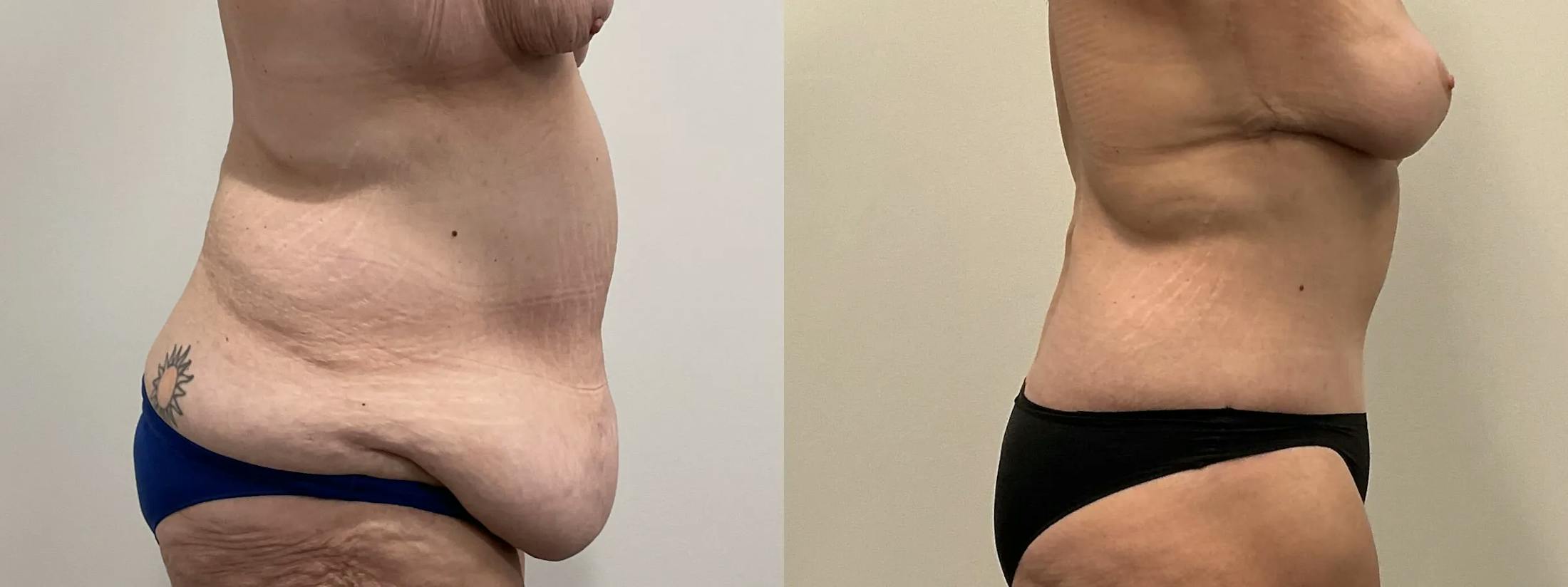 Tummy Tuck Before & After Gallery - Patient 247048 - Image 2