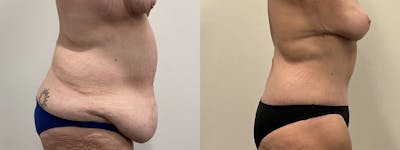 Tummy Tuck Before & After Gallery - Patient 247048 - Image 2