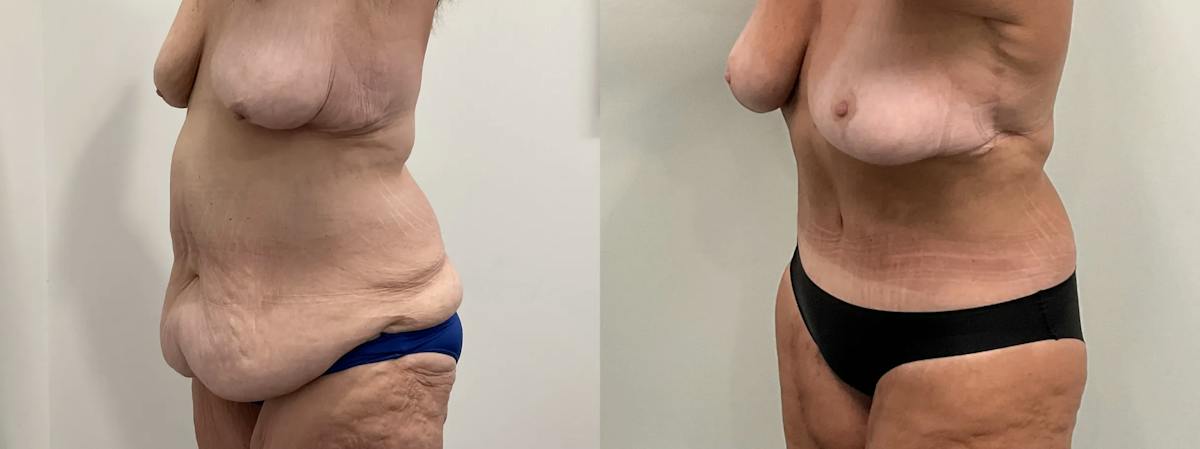 Tummy Tuck Before & After Gallery - Patient 247048 - Image 3