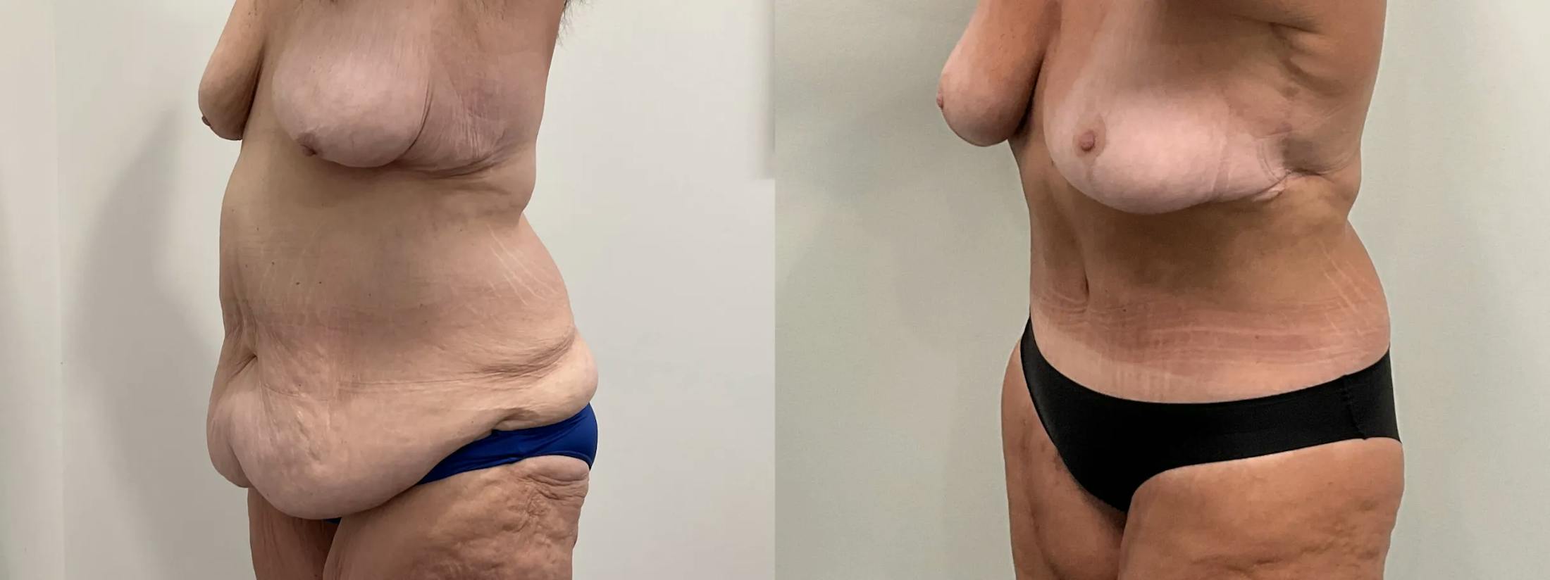 Tummy Tuck Before & After Gallery - Patient 247048 - Image 3
