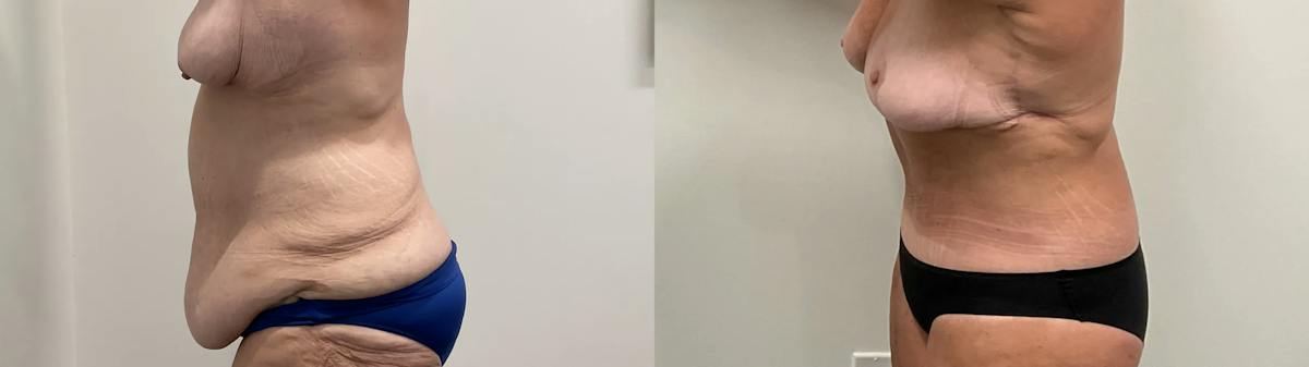 Tummy Tuck Before & After Gallery - Patient 247048 - Image 4