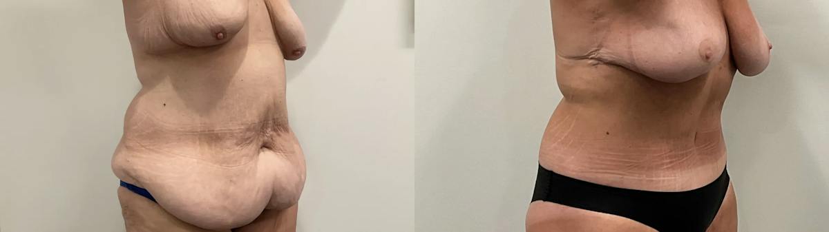 Tummy Tuck Before & After Gallery - Patient 247048 - Image 5