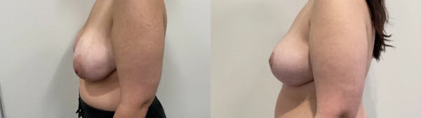 Breast Reduction Before & After Gallery - Patient 618012 - Image 1