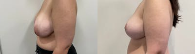 Breast Reduction Before & After Gallery - Patient 618012 - Image 1