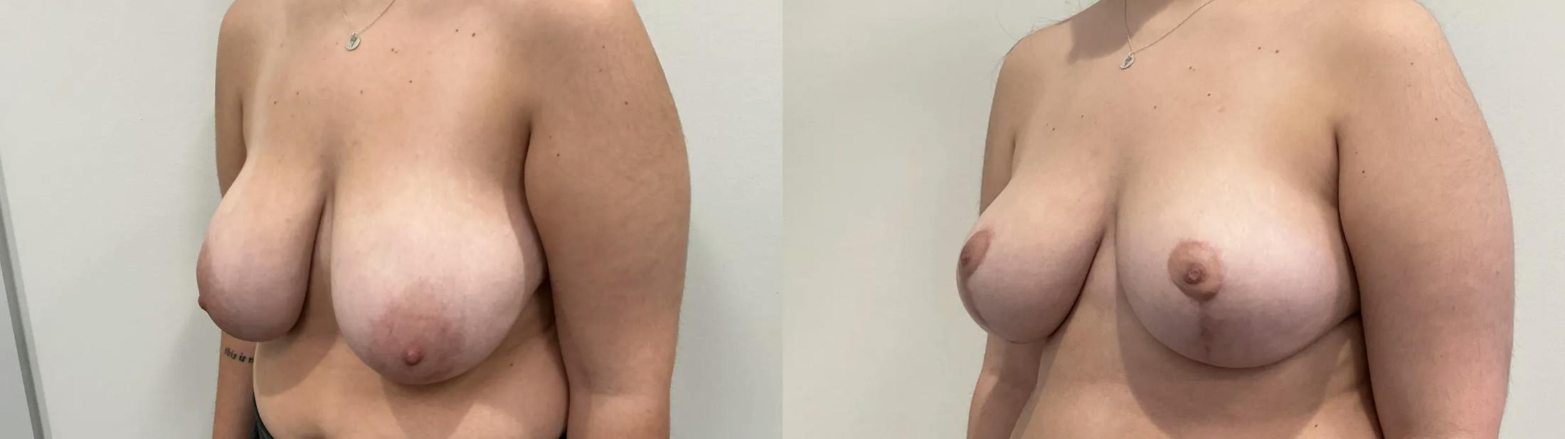 Breast Reduction Before & After Gallery - Patient 618012 - Image 2