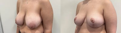 Breast Reduction Before & After Gallery - Patient 618012 - Image 2