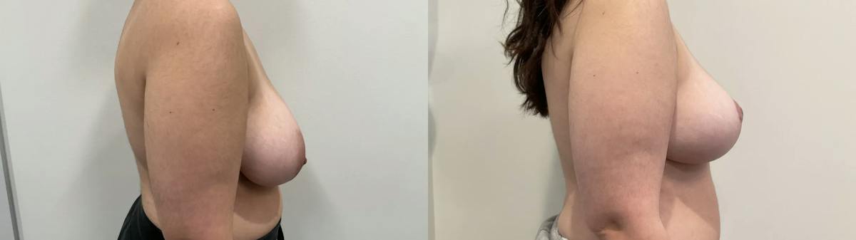 Breast Reduction Before & After Gallery - Patient 618012 - Image 3