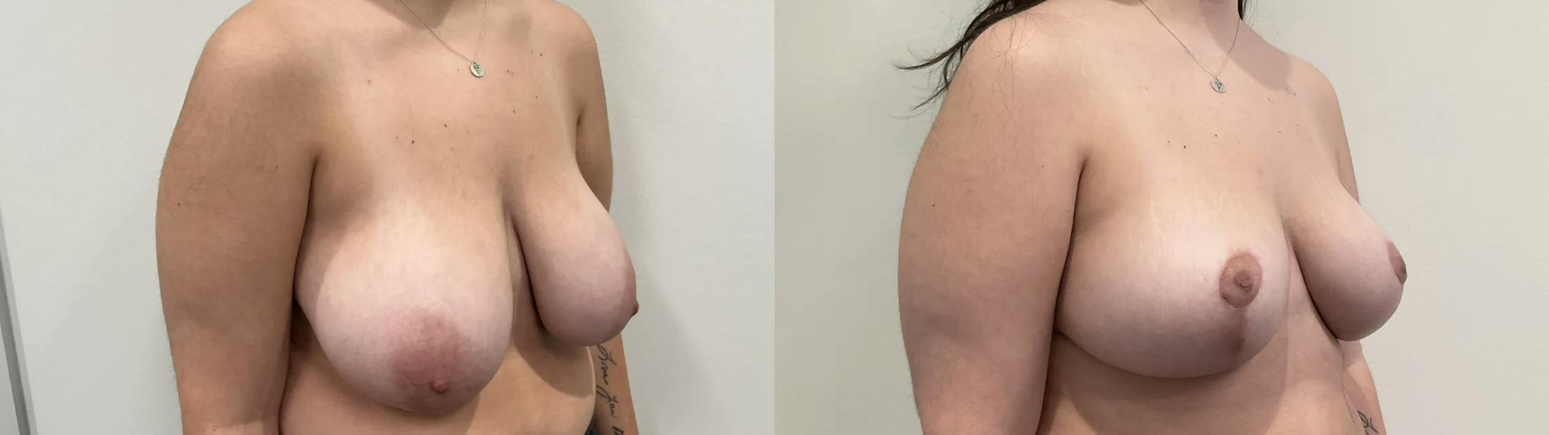 Breast Reduction Before & After Gallery - Patient 618012 - Image 4