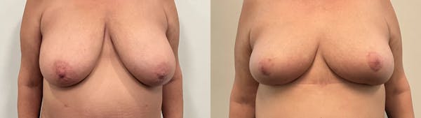 Breast Reduction Before & After Gallery - Patient 129334 - Image 1