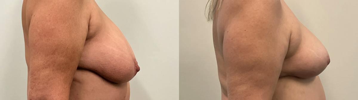 Breast Reduction Before & After Gallery - Patient 129334 - Image 2