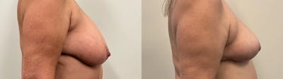 Breast Reduction Before & After Gallery - Patient 129334 - Image 2