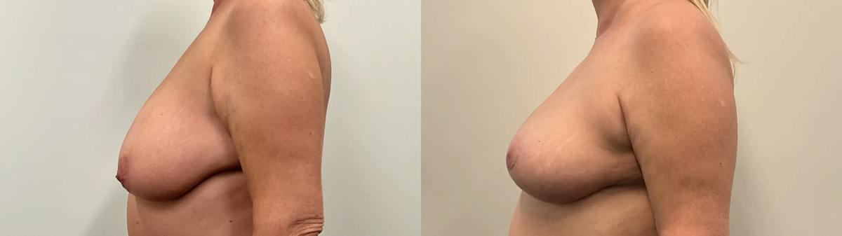 Breast Reduction Before & After Gallery - Patient 129334 - Image 3