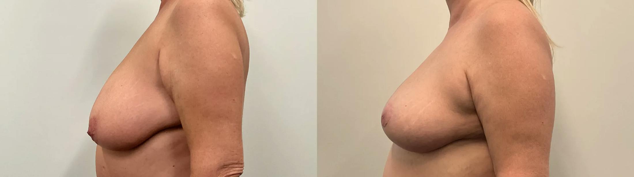 Breast Reduction Before & After Gallery - Patient 129334 - Image 3